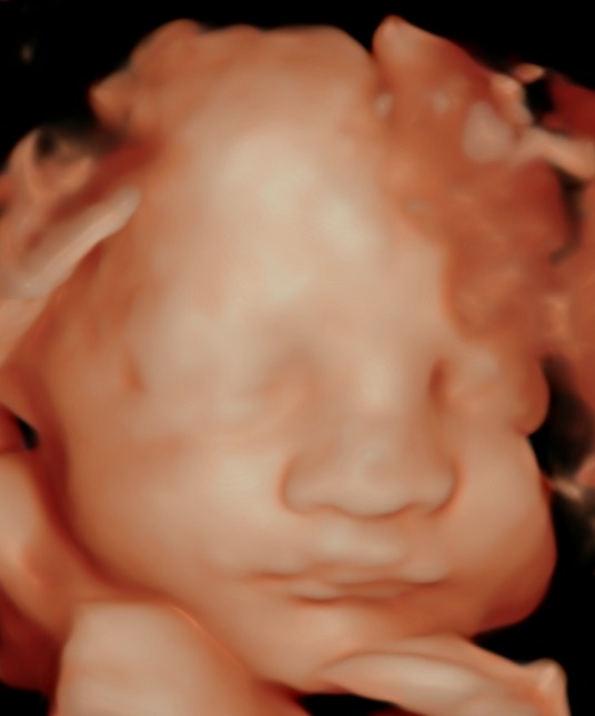 3D/4D Pregnancy Ultrasound