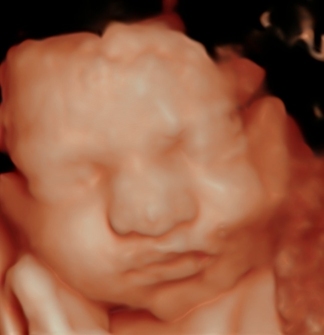 3D/4D Pregnancy Ultrasound